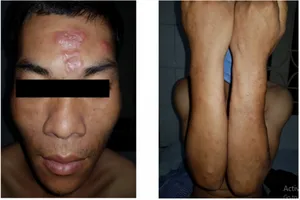 Cảnh báo căn bệnh dần bị lãng quên bắt đầu quay trở lại