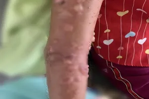 Bé gái nhập viện vì bỏng da nặng do tiếp xúc sứa biển 