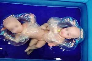 Gần 100 y bác sĩ chuẩn bị mổ tách dính ca song sinh phức tạp