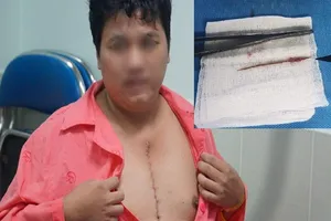 Hi hữu: Tăm đâm vào tim cả tháng trời không hề hay biết