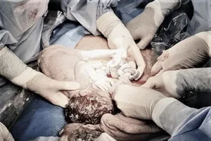 Cứu sống song thai với dây rốn xoắn lò xo, thắt nút nhiều lần