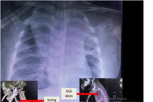 Bé trai nguy kịch vì mảnh xương lươn cắm chặt thực quản 5 ngày