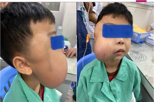 Căn bệnh khiến hàm bé trai sưng to, chảy máu mũi nhiều năm