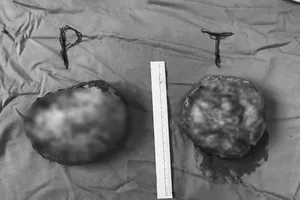 Biến dạng ngực sau khi đặt túi ngực nhân tạo 1 tuần