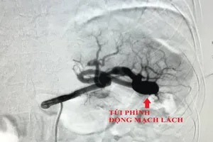 Đau bụng 6 tháng vì căn bệnh có thể gây đột tử mà không biết