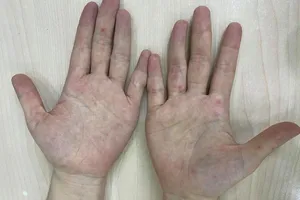 Người phụ nữ đi khám da liễu phát hiện mắc tay chân miệng