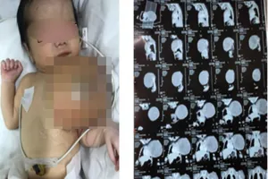 Bé trai mới sinh mang 'quả bóng khủng' trước ngực