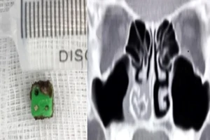 Nguyên nhân không ngờ khiến bé trai hay chảy máu mũi