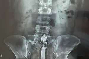 Giải cứu nam thanh niên bị kẹt dương vật giả trong trực tràng