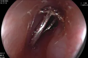 Bé gái 10 tuổi khóc nấc vì nghẹn chiếc nhẫn mới được tặng