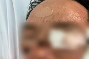 Đang ngồi nhậu bị pháo nổ trúng vào người phải cấp cứu