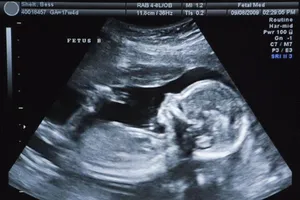 Kỳ lạ bé gái mang người anh em sinh đôi trong bụng