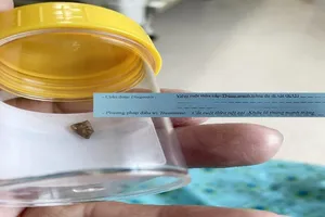 Khám sức khỏe vô tình phát hiện xương gà đâm ruột 