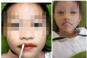 Hình ảnh bé gái năm tuổi bị phun môi thẩm mỹ lan truyền trên mạng. Ảnh: MXH 