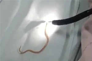 Bé trai 5 tuổi bị viêm tụy cấp do giun chui vào ống tụy 