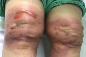 Sưng nề, phỏng rộp toàn bộ 2 khớp gối vì đắp lá thuốc xào giấm