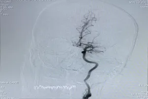 Khi đang quét sân, người đàn ông đột nhiên lơ mơ, mất ngôn ngữ 