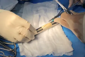 Bác sĩ dùng màng ngoài tim bò tạo đoạn động mạch chủ bụng bị hư cứu bệnh nhân