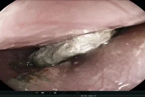 Viên pin cúc áo mắc kẹt hơn 5 giờ trong thực quản bé trai