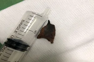 20 năm ho ra máu, mủ vì mảnh xương heo to bị bỏ quên trong phổi