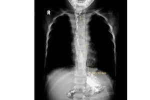 Uống nhầm nước tro tàu, trẻ bị hẹp toàn bộ thực quản