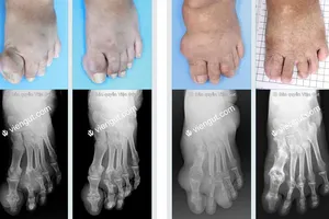 Nhiều bệnh nhân gút biến chứng phục hồi nhờ mô hình này