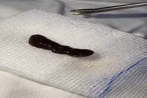 Bé trai bị chảy máu mũi, bác sĩ xử lý lấy ra một con vắt căng máu