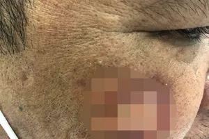 Tưởng bệnh về da, hóa ra bệnh tâm thần