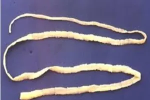 Sán xơ mít hơn 10 mét làm ổ trong người nam bệnh nhân