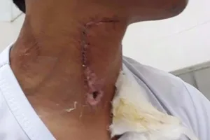 Nhập viện vì bị trâu hàng xóm húc thủng cổ