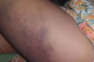 1 học sinh lớp ba bị cô giáo đánh bầm tím đùi