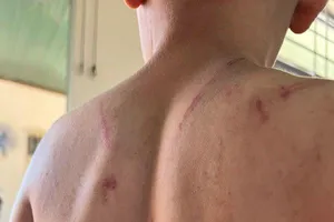 Khởi tố vụ án bé trai 9 tuổi bị cha và bà nội đánh đập 