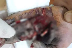 Điện thoại đang sạc phát nổ làm nát bàn tay thiếu niên