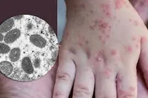 Sau Đồng Nai, Bình Dương ghi nhận người đầu tiên mắc đậu mùa khỉ