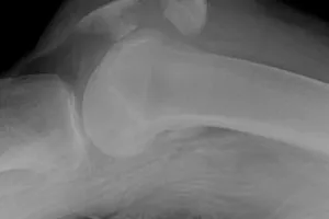 Tử vong chỉ vì gãy chân