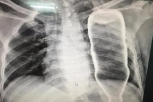 Hi hữu: Mổ cấp cứu lấy chai nước khỏi lồng ngực