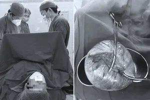 Mổ lấy khối u ‘khủng’ gần 2 kg cứu thai phụ và cháu bé
