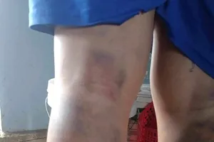 Cảnh cáo cô giáo đánh học sinh 2 chân bầm tím