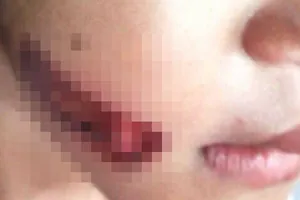Khởi tố vụ bé 7 tuổi nghi bị gí sắt nóng vào người