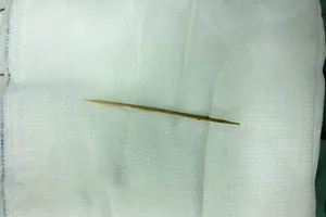 Tăm xỉa răng lọt vào bụng đâm thủng ruột non