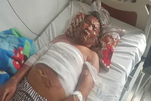 Chồng tai biến vẫn cố bò đến cứu vợ bị bỏng do xì gas