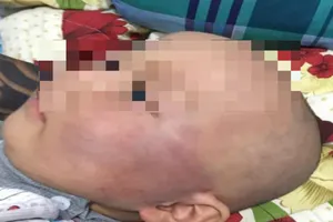 Bé trai bị tát bầm mặt: Gia đình không chấp nhận xin lỗi