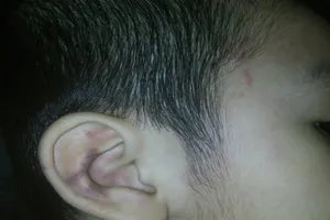 Đi học về, bé 5 tuổi sưng bầm tai nghi bị bảo mẫu đánh