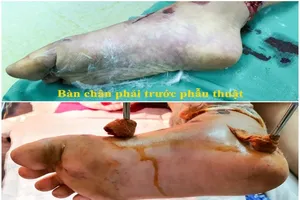 2 bệnh viện chạy đua cứu sống bàn chân bé gái