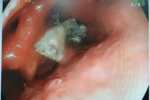 Hình ảnh nội soi hàm răng giả trong họng bệnh nhân