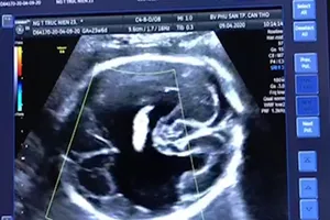 Cần Thơ: Phát hiện thai nhi bị dị tật chẻ não cực kỳ hiếm gặp