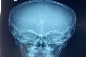 Chơi đùa, bé trai té ngã bị mảnh kính găm trong trán 2 ngày