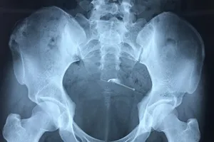 Hi hữu: Vòng tránh thai 'lạc trôi' xuyên thành bàng quang 