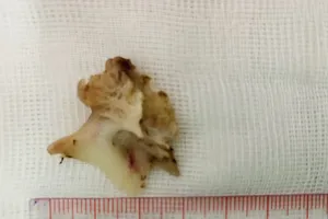 Hóc xương đầu cá, người đàn ông nhập viện cấp cứu