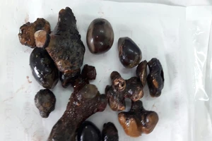 Xẻ đôi thận, lấy nhiều sỏi san hô cho người đàn ông 60 tuổi